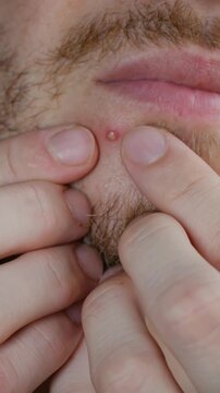Extreme close up of a bearded man squeezing a pustule on his face near his mouth, showing the process of popping a pimple with pus coming out of the infected pore as a result of acne. Vertical video