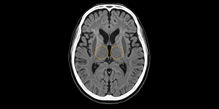 Brain CT Scan Illustration with Bilateral Thalamus Highlighted by Yellow Circles