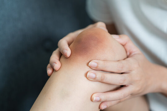 Close up of stain bruise wound on arm, contusion asian young woman, girl an accident fell down stairs, hand on knee in healing injury by massage hematoma blood
