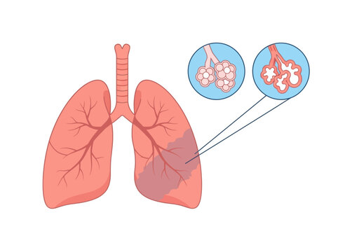 Human Lungs Medical Illustration with Alveoli Comparison Showing Healthy vs Inflamed Air Sacs for Pneumonia and Respiratory Disease Education