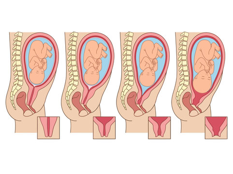 Medical Illustration of Cervical Effacement and Dilation Stages During Childbirth and Labor