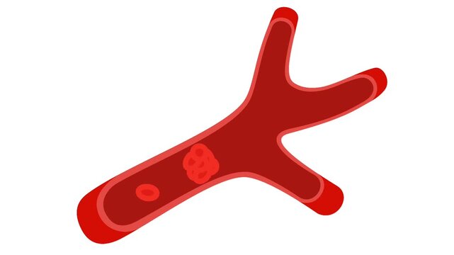 Animation of a blood clot inside a blood vessel.