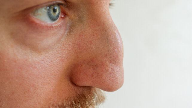 Macro extreme close up profile of male nose before rhinoplasty plastic surgery