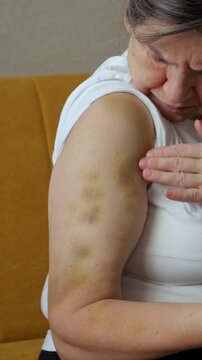 Middle aged woman examines bruised upper arm on sofa, gently pressing skin with concerned focus. Close home health moment shows visible discoloration as she checks possible soreness on shoulder.