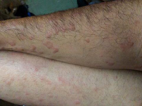 infection allergy refers to the immune system overreacting to allergen, triggering a histamine response that causes allergic symptoms like itching, selective focus, shallow depth of field, Cairo Egypt