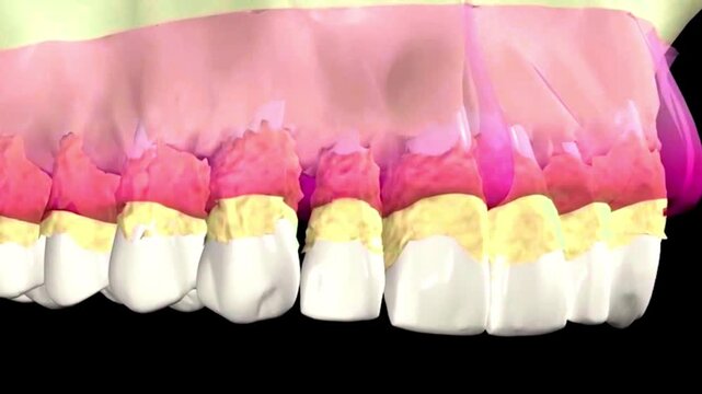 3D tooth model reveals harmful bacteria and decay before showing effective dental cleaning.