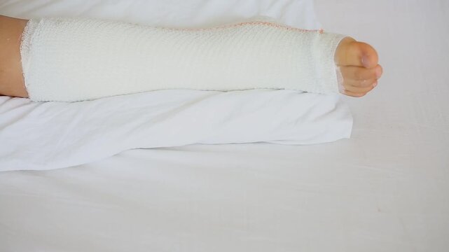 Children's leg in orthopedic cast on a white bed in the orthopedic department after first aid. Broken leg in a cast of an young child. 