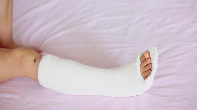 Broken leg in a orthopedic cast of an young child. A unrecognizable little girl with a broken leg at home on the bed. 