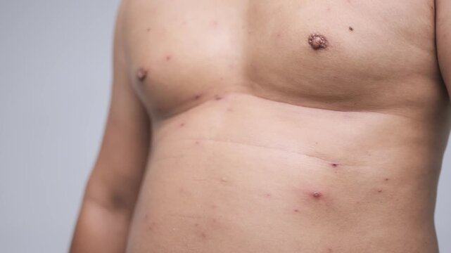 Close-Up of Adult Male Torso with Chicken Pox Blisters and Red Skin Rash