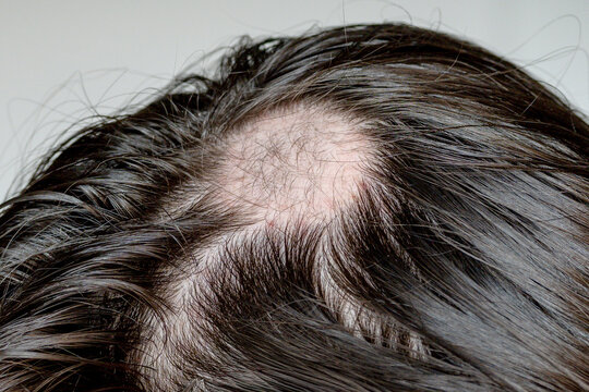 Close-up of alopecia areata during hair regrowth, with fine new hairs visible within a recovering bald patch.