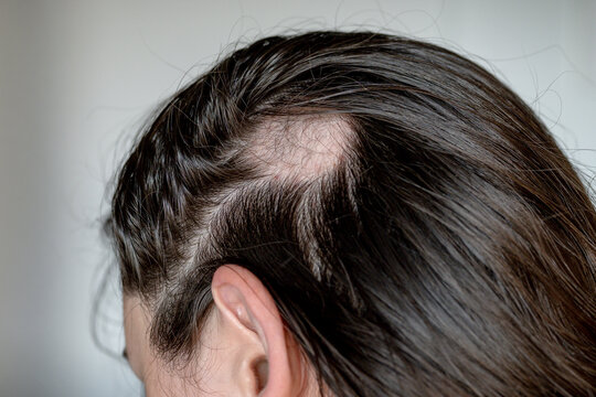 Close-up of alopecia areata during hair regrowth, with fine new hairs visible within a recovering bald patch.