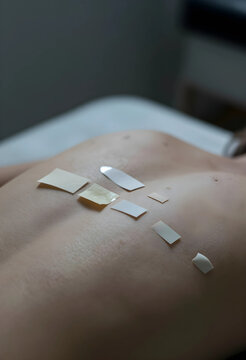 Allergy testing and dermatology diagnosis, skin patch test on patient back for contact dermatitis and skin sensitivity assessment in medical clinic