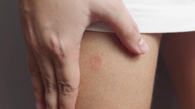 Person examines red mark on thigh, gently touching skin beneath raised white clothing. Close view shows fingers checking small irritated spot as concern and curiosity prompt careful inspection.