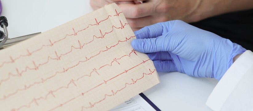 Doctor in blue gloves holding ECG printout showing heart rhythm on paper strip