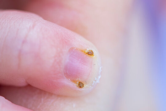 Extreme close-up of infected finger nail with paronychia inflammation