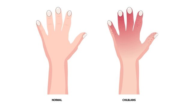 Medical vector animation displaying an anatomical comparison between a healthy hand and cold-exposed fingers with erythematous swelling and petechial lesions, highlighting chilblains,frostnip