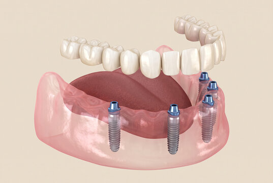 Full arch fixed dental bridge on lower jaw implants, 3D medical illustration of implant-supported teeth restoration with transparent gums and blue abutments