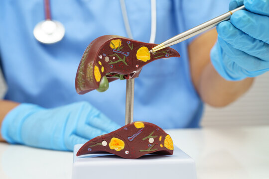 Cirrhosis, Liver cancer, fatty liver, Asian doctor with liver human anatomy model in World Hepatitis Day at hospital.