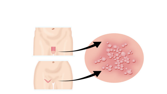 Genital lesions of HSV, Medical illustration showing characteristic clustered vesicular lesions of genital herpes infection, highlighting the affected genital skin and enlarged view of the lesions.