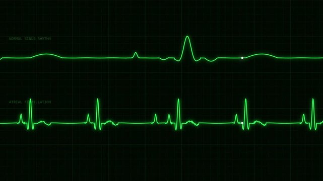 Comparison of normal sinus rhythm and atrial fibrillation electrocardiogram heart monitor screens