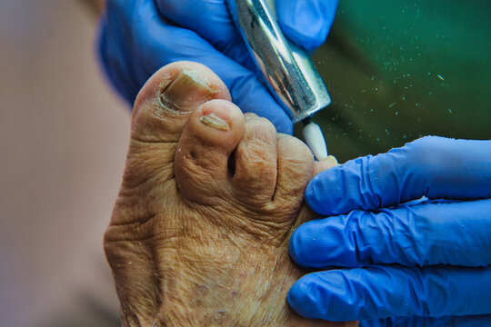 Medical professional treats elderly foot with precision. Blue gloves protect hands during careful procedure. Instrument gently cleanses worn toenail surface