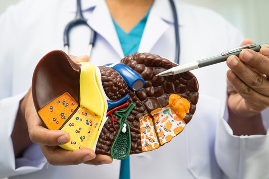 Cirrhosis, Liver cancer, fatty liver, Asian doctor with liver human anatomy model in World Hepatitis Day at hospital.
