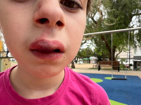 Close-up series of a young girl's face showing a swollen and bruised upper lip after an accidental fall at a playground.