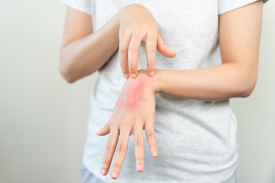 Dermatology asian young woman allergy, allergic reaction from atopic, insect bite, scratching itchy back of hand, red spot or rash of skin. Healthcare treatment of beauty. Isolated on white background