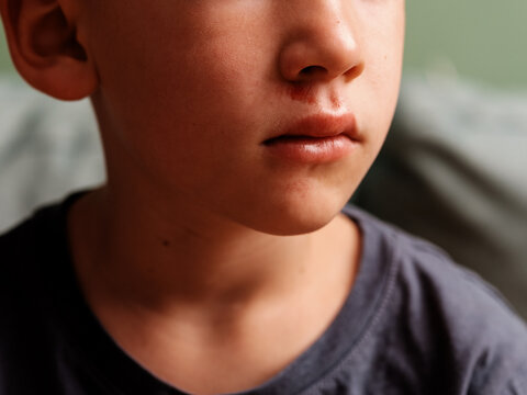 Close-Up Portrait Of Anonymous Child With Injury On His Face
