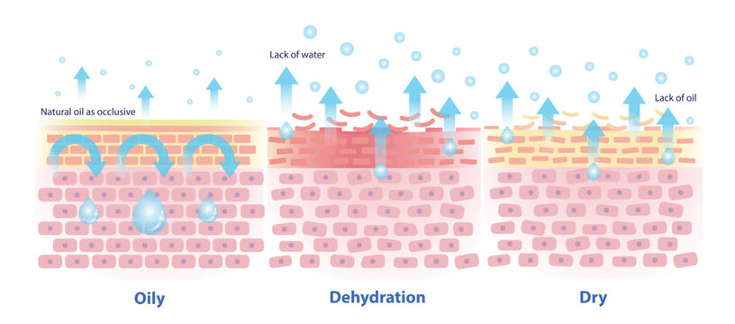 Comparison of transepidermal water loss oily, dehydration and dry skin illustration. Oily, natural oil as occlusive that help trap in water, hydration, less TEWL compare to dehydrated and dry skin.
