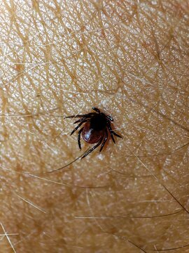 A tick has attached itself to human skin.