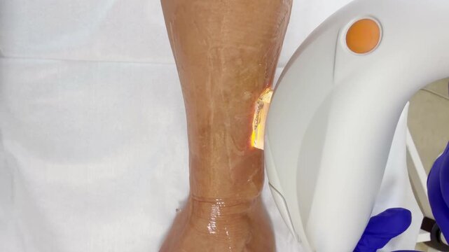 Doctor Hand in Glove Holding IPL Handpiece During Phototherapy Treatment on Patient Arm &ndash; Intense Pulsed Light Procedure with Light Flashes