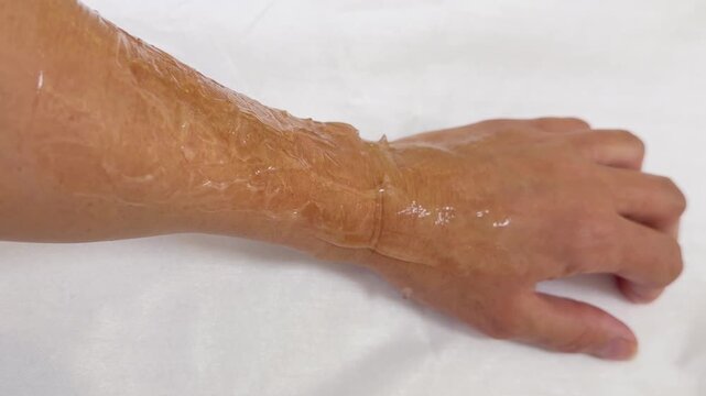Doctor Hand in Glove Holding IPL Handpiece During Phototherapy Treatment on Patient Arm &ndash; Intense Pulsed Light Procedure with Light Flashes