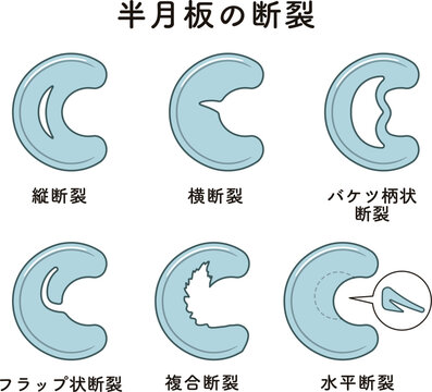ひざ関節の半月板の断裂 Knee meniscus tear