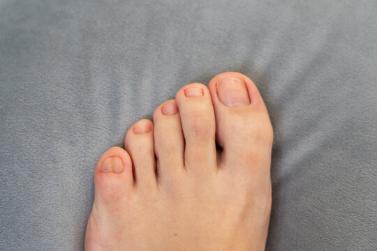 Female feet with big double little toe