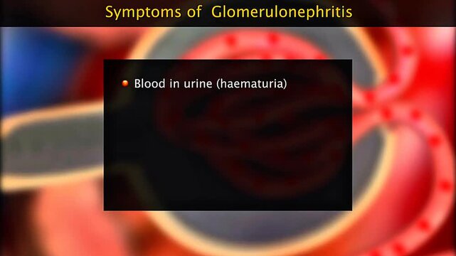 Glomerulonephritis symptoms include bloody or foamy urine, swelling, hypertension, fatigue, and reduced urination.