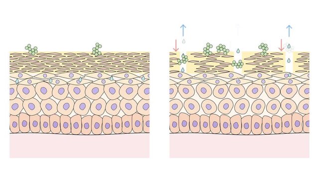 Healthy vs atopic dermatitis skin barrier side by side, water loss and Staphylococcus aureus entering through lipid gaps in stratum corneum, seamless loop 4K medical animation.