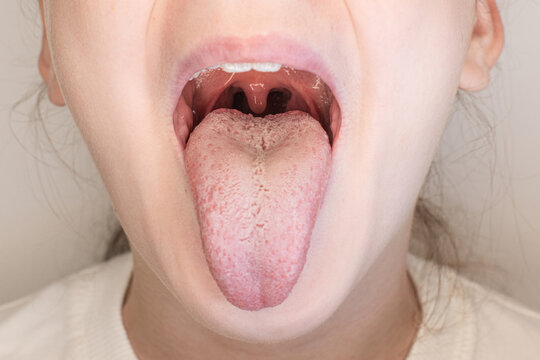 Macro shot of open child's girl mouth showing coated tongue, throat, and uvula during medical exam