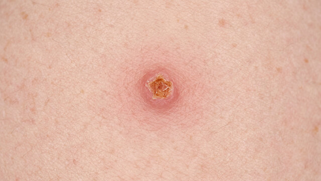 Macro Close Up of Skin Lesion With Scab and Red Inflamed Area Insect Bite or Infected Wound Dermatology Concept