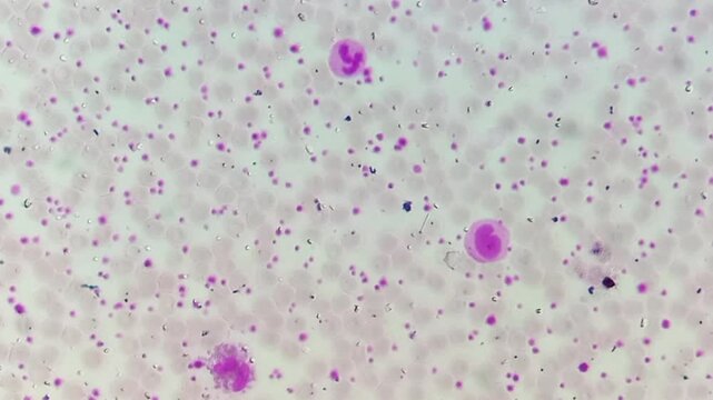 Thrombocytosis. Platelet increased in number. Microscopic footage of complete blood count (CBC). 