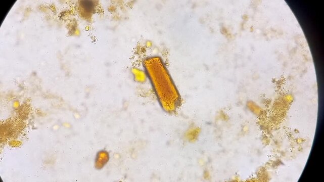 Microscopic footage of stool analysis showing Muscle fibers. Microscopic footage of stool. 