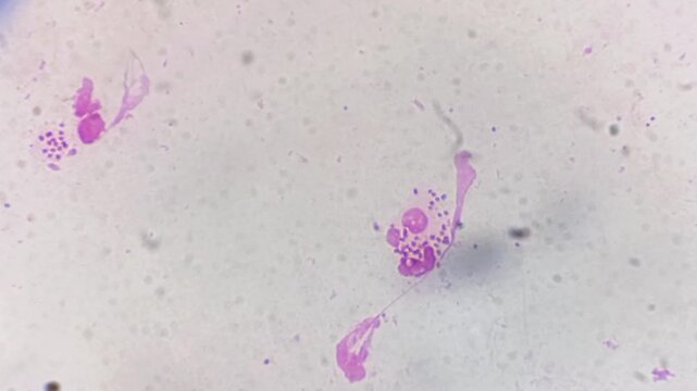 Microscopic footage of urethral smear for Gram stain. Gram negative intra and extracellular diplococci are seen.