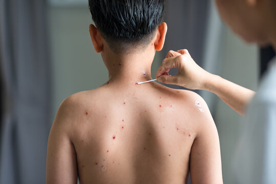 Caregiver hand applying ointment with cotton swab to chickenpox varicella blisters on boy neck and back