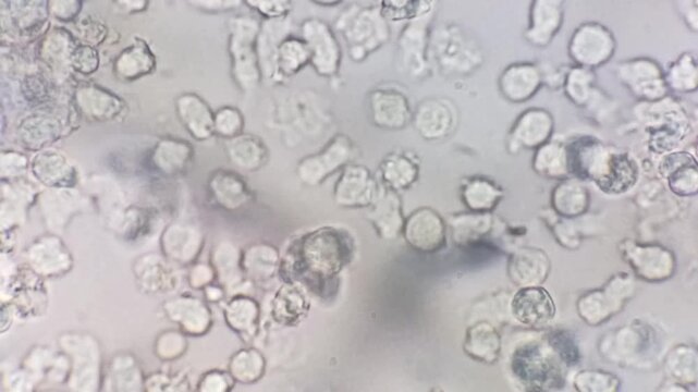 Microscopic footage of the urinalysis showing plenty Pus cells.