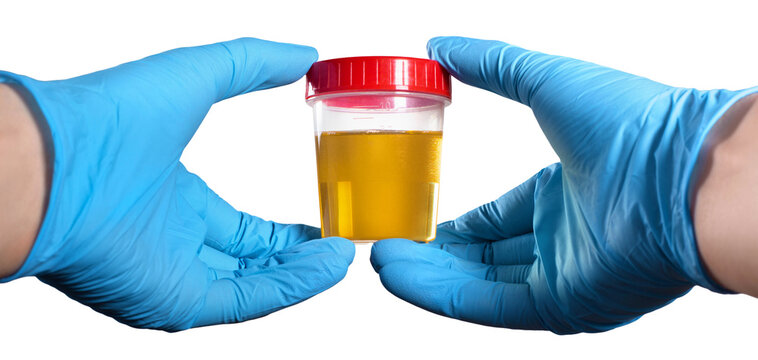 Medical gloved hands holding urine test sample in plastic container, isolated on transparent cutout background