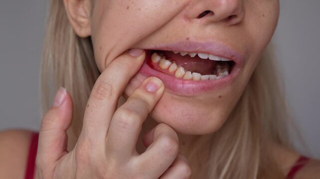 Young woman pulls her lip down to show blood and irritated gums near the teeth, demonstrating bleeding gums and oral hygiene issue