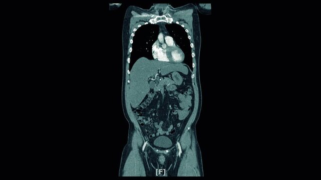 Body mri Imaging or ct scan of x-ray body shows Internal Organs and Liver,Lungs,Intestines,Stomach,Bladder,Kidneys.