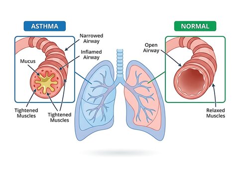 Comparison diagram of normal lung airway versus constricted asthmatic bronchial