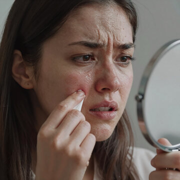 Cyberpunk Skin Upset. A Woman With Acne Squeezes A Pimple At Home Using A Mirror