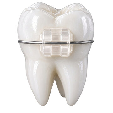 Tooth with clear orthodontic bracket and metal wire